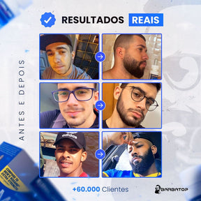 Minoxidil Kirkland 5% Original - Para 1 Mês (1 Frasco de 60ml)